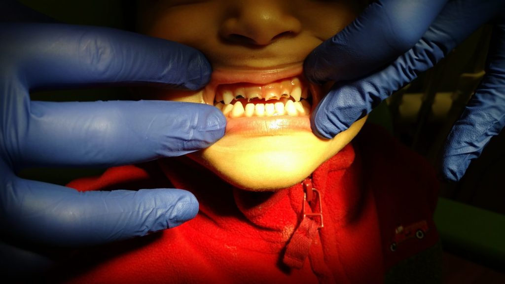Photo of Early Childhood Caries